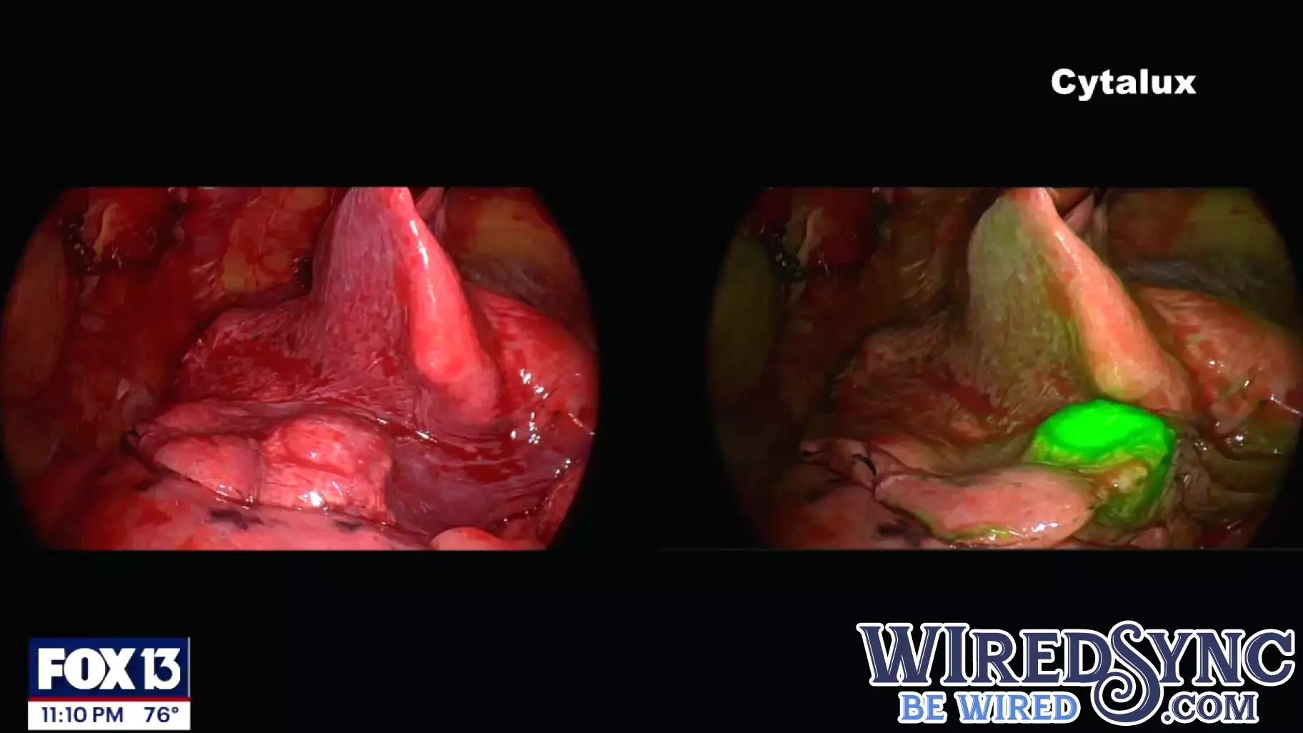 Innovative Technology Enhances Lung Cancer Detection
