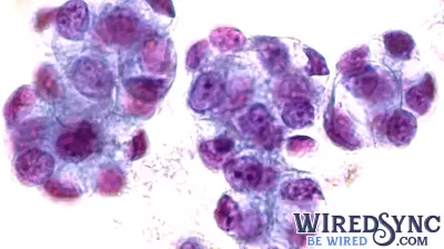 Innovative Organ Chip Technology Offers Hope for Predicting Chemotherapy Success in Esophageal Adenocarcinoma